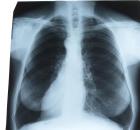 płuca zdjęcie rtg.jpg